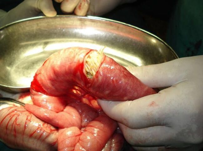 worms in human intestines