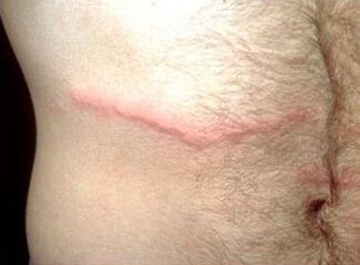 How to get rid of subcutaneous parasites in people
