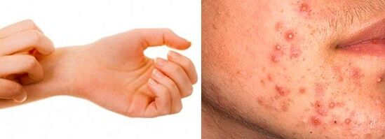 Symptoms of subcutaneous parasites in people