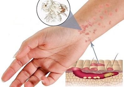manifestations of the presence of subcutaneous parasites in people